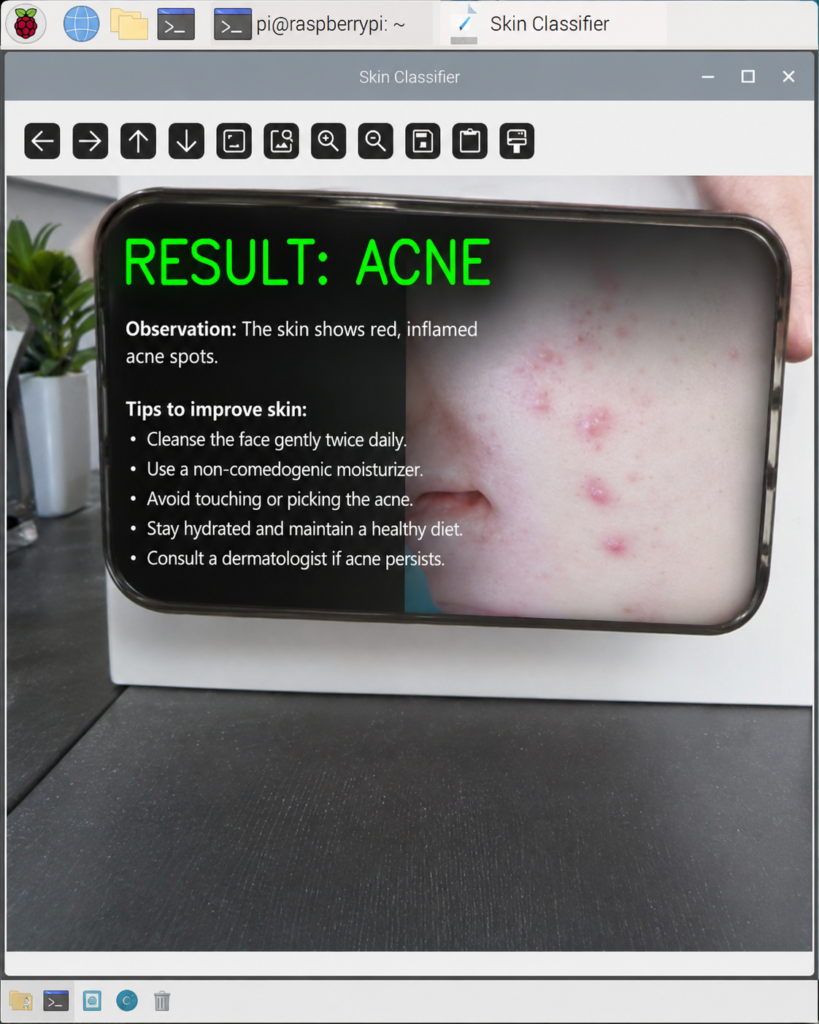 Raspberry Pi skin classifier interface showing the result “Acne,” with a facial image, visible acne spots, and general skincare recommendations.